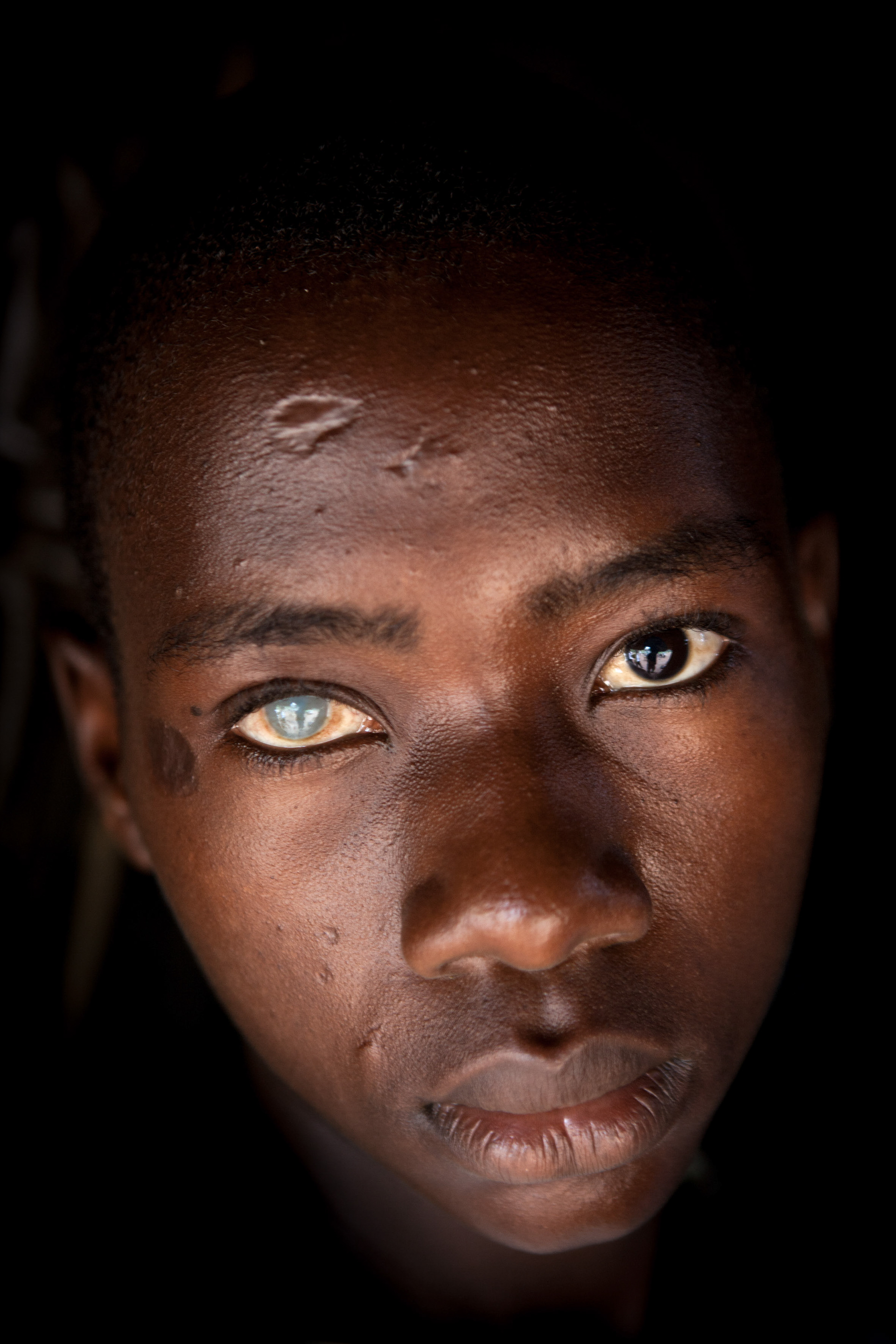 Esekyel Wéazama was 9 years old when he was victim of the same grenade. With the resurgence of the fighting in the region, numerous explosive devices have been fired or abandoned- the population is afraid of new accidents.
