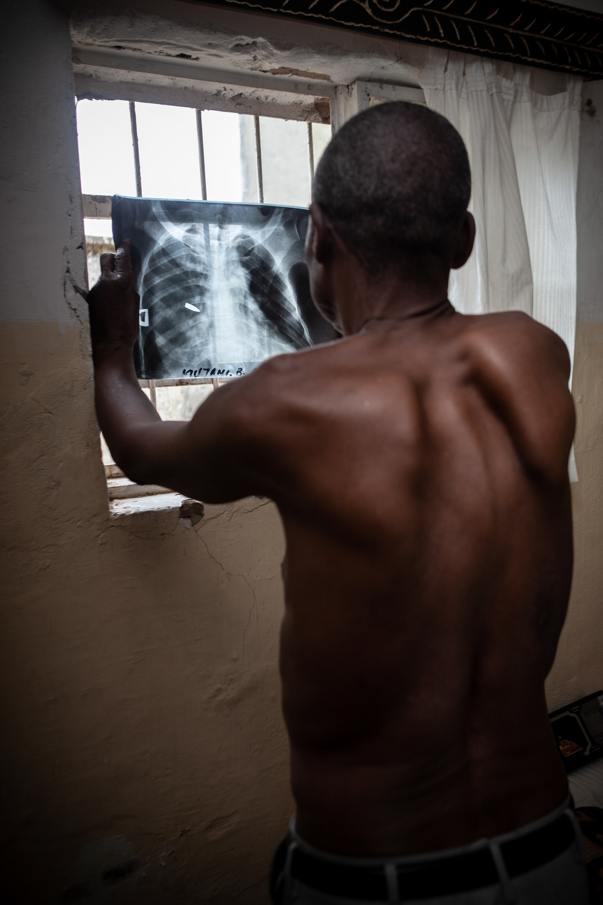 Boniface Mujani received a stray bullet during the riots that followed the destruction of his village by the mine police. He has never received the compensation $(900) that would allow him to extract the bullet.