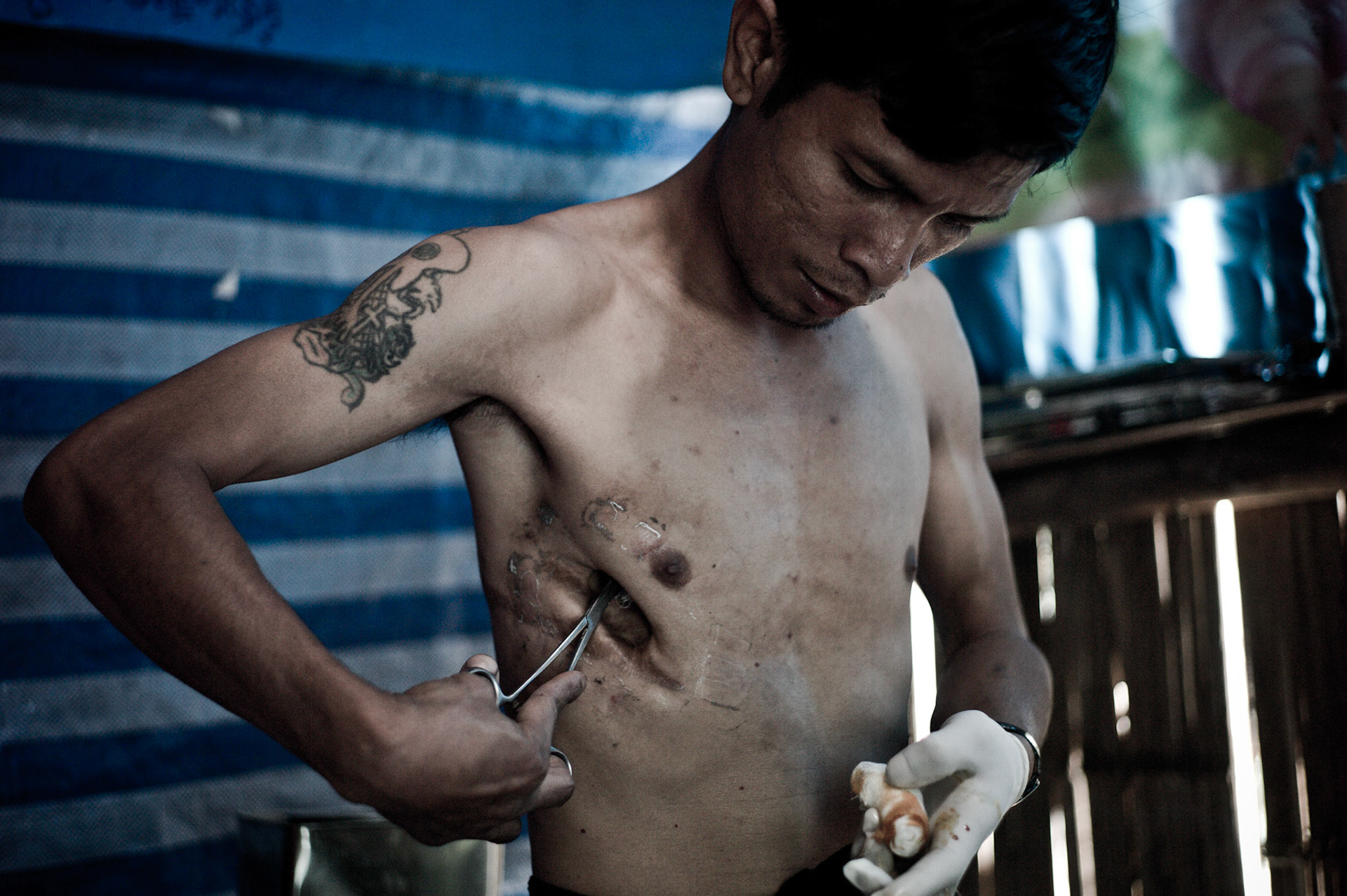 The injuries he suffered whilst tortured under interrogation lead to the removal of two of the three lobes in his right lung. The open wound needs urgent medical treatment but whilst waiting for resettlement to a third country he has to care for himself.