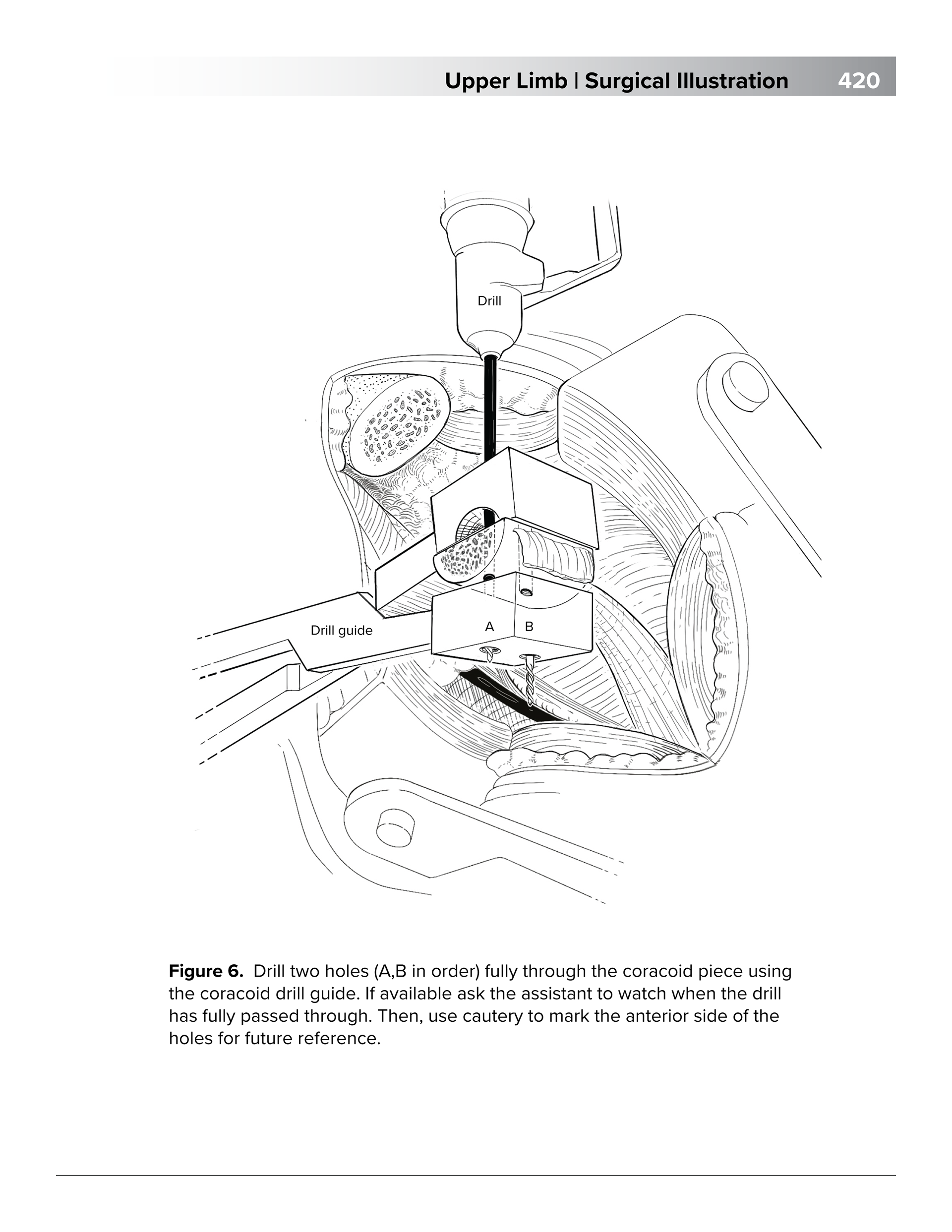 Coracoid drill holes