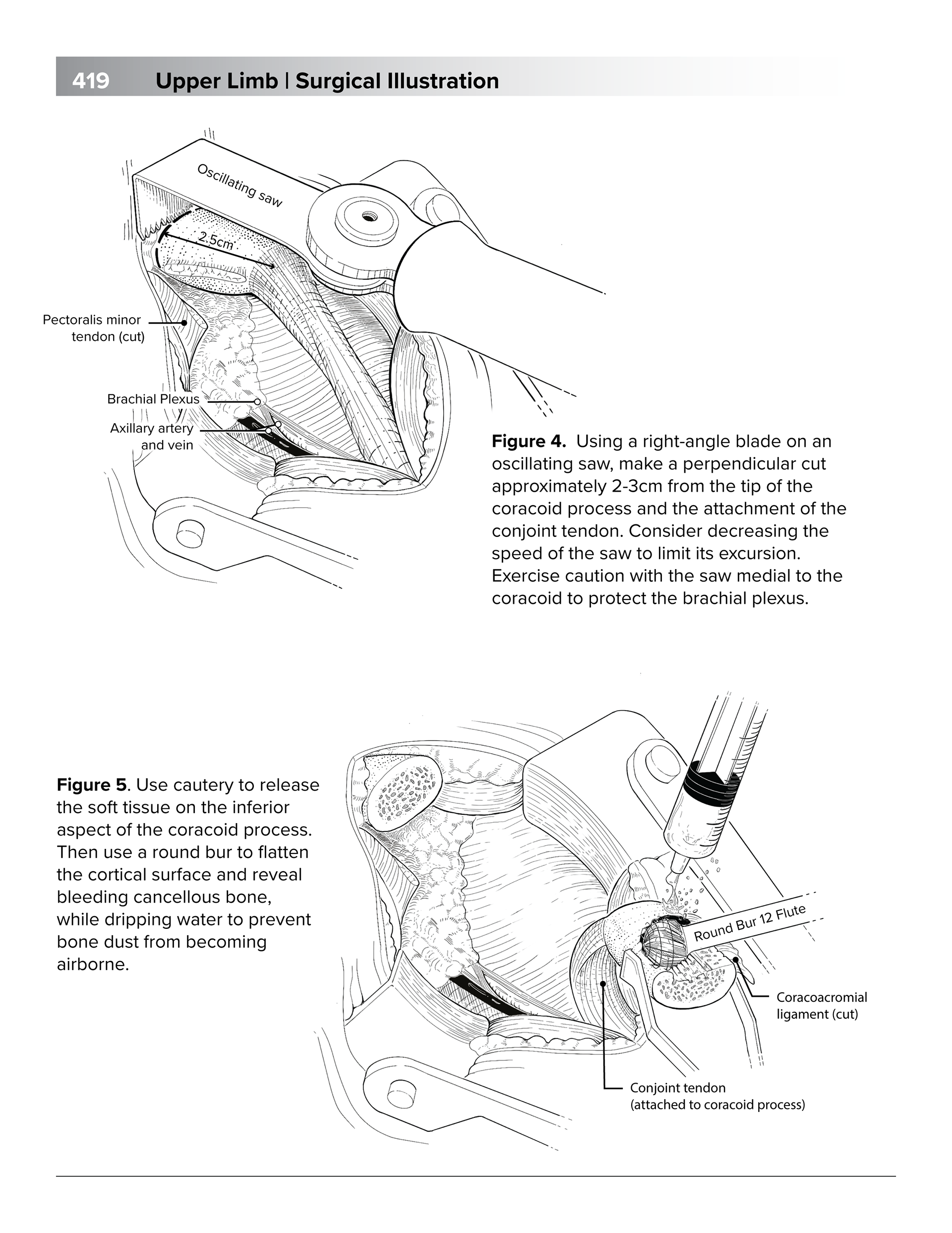 Coracoid process removal