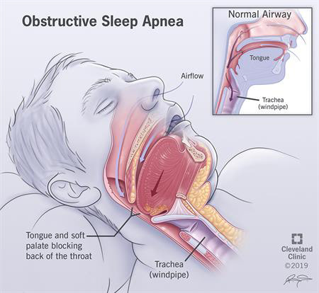 How sleep apnea obstructs airways