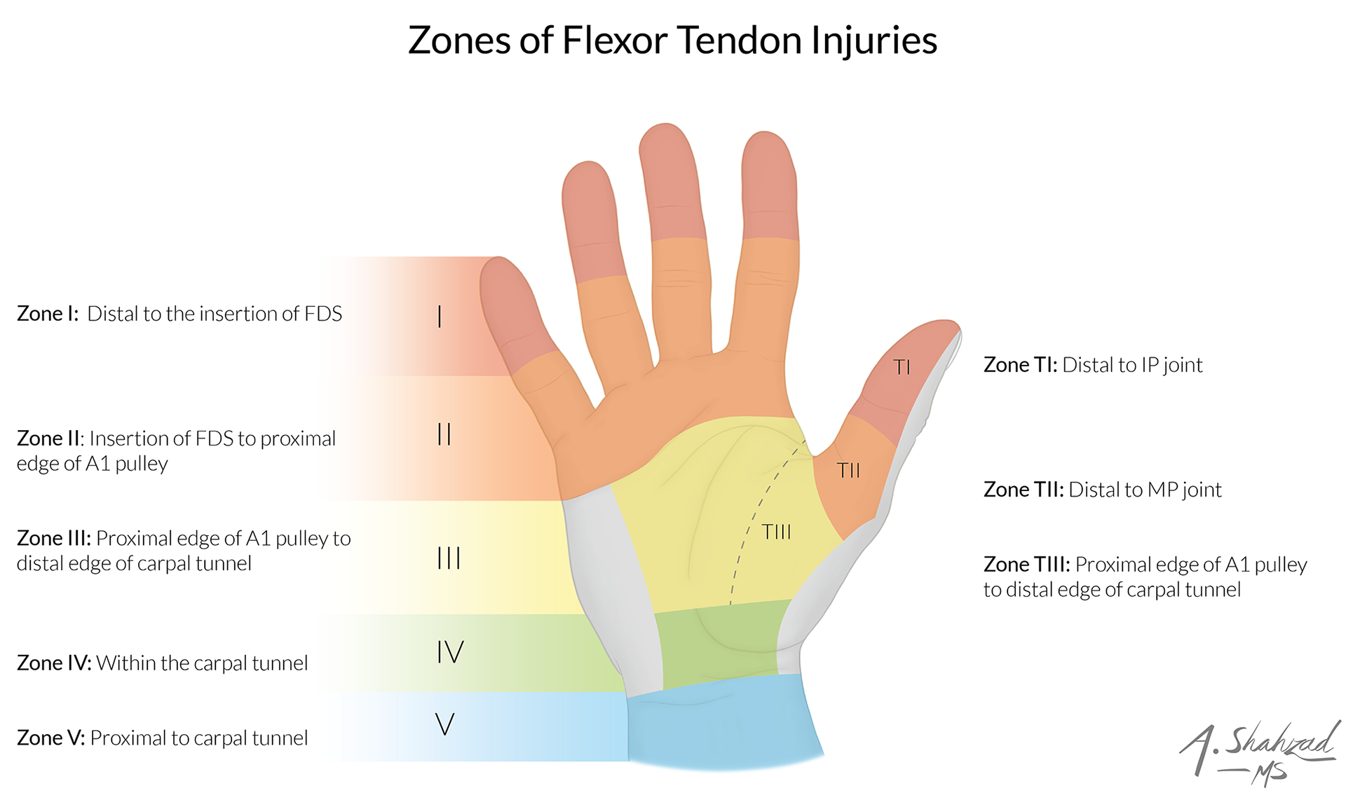 An original, color-coded illustration of the flexor zones of the hand, created to bring a clean and modern aesthetic to one of the most established and recognizable diagrams in plastic surgery. My goal with this piece was to honor the classic representation while providing learners with a refreshed, visually engaging perspective that simplifies complex anatomy without sacrificing accuracy.