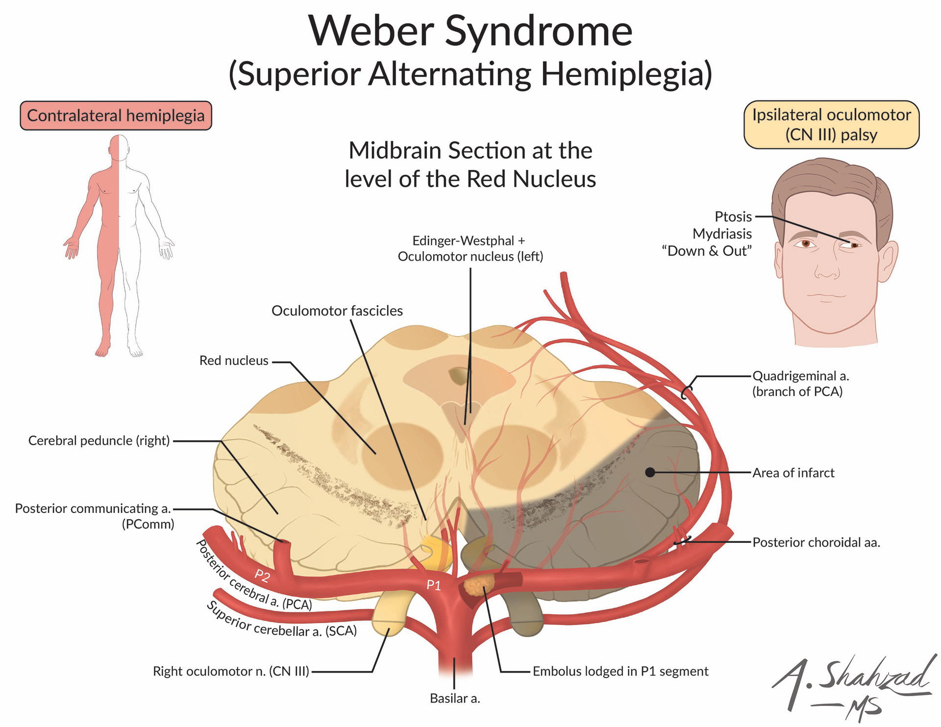 An original illustration of Weber Syndrome, created out of my personal interest in neuroanatomy to highlight the vascular supply and clinical manifestations of a ventral midbrain infarct