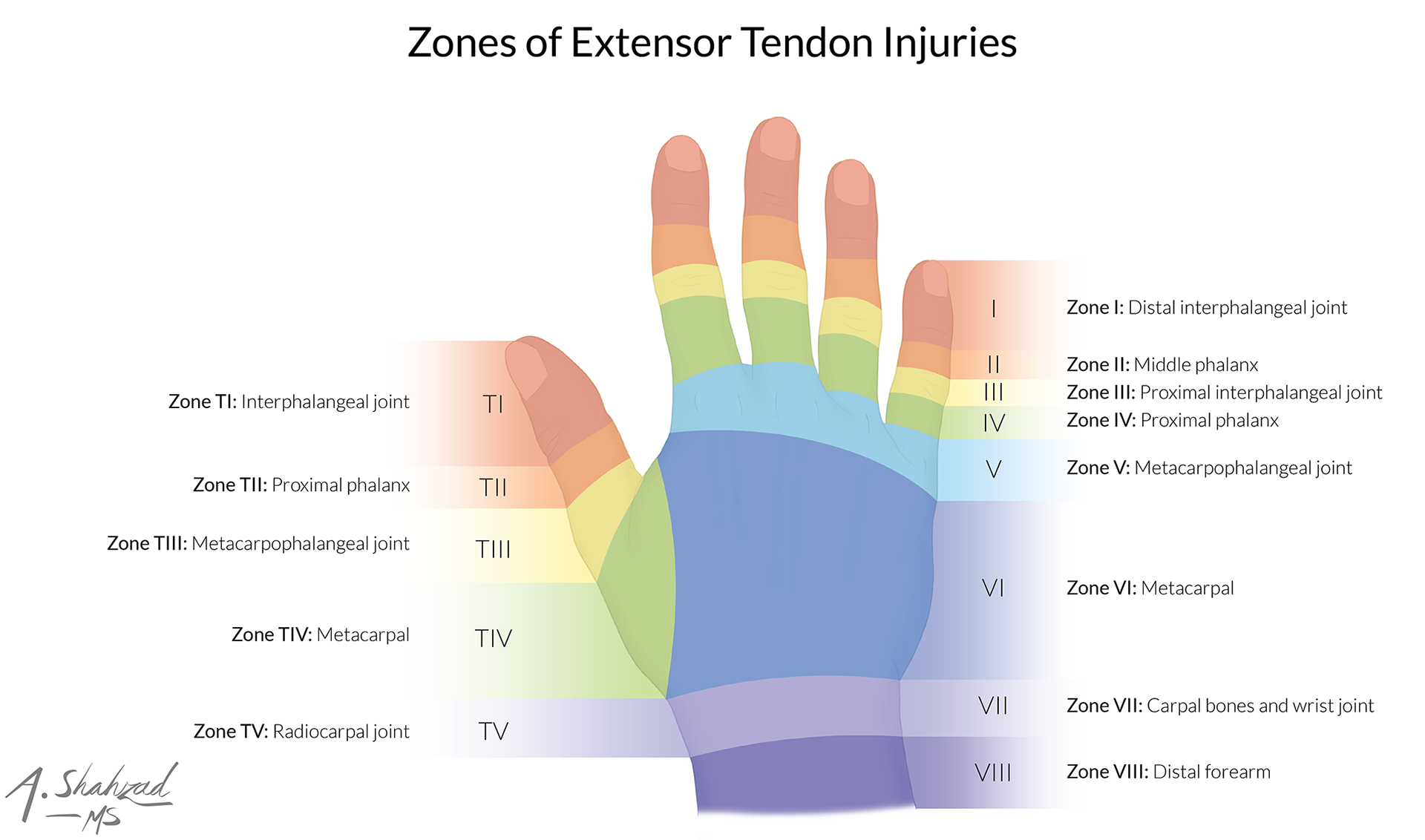 An original illustration of the extensor zones of the hand, designed as a companion to my flexor zones artwork. Together, these two pieces provide a comprehensive and modern visualization of the classic hand zone system in plastic surgery, giving readers a clearer grasp of this foundational concept through a clean and cohesive design.