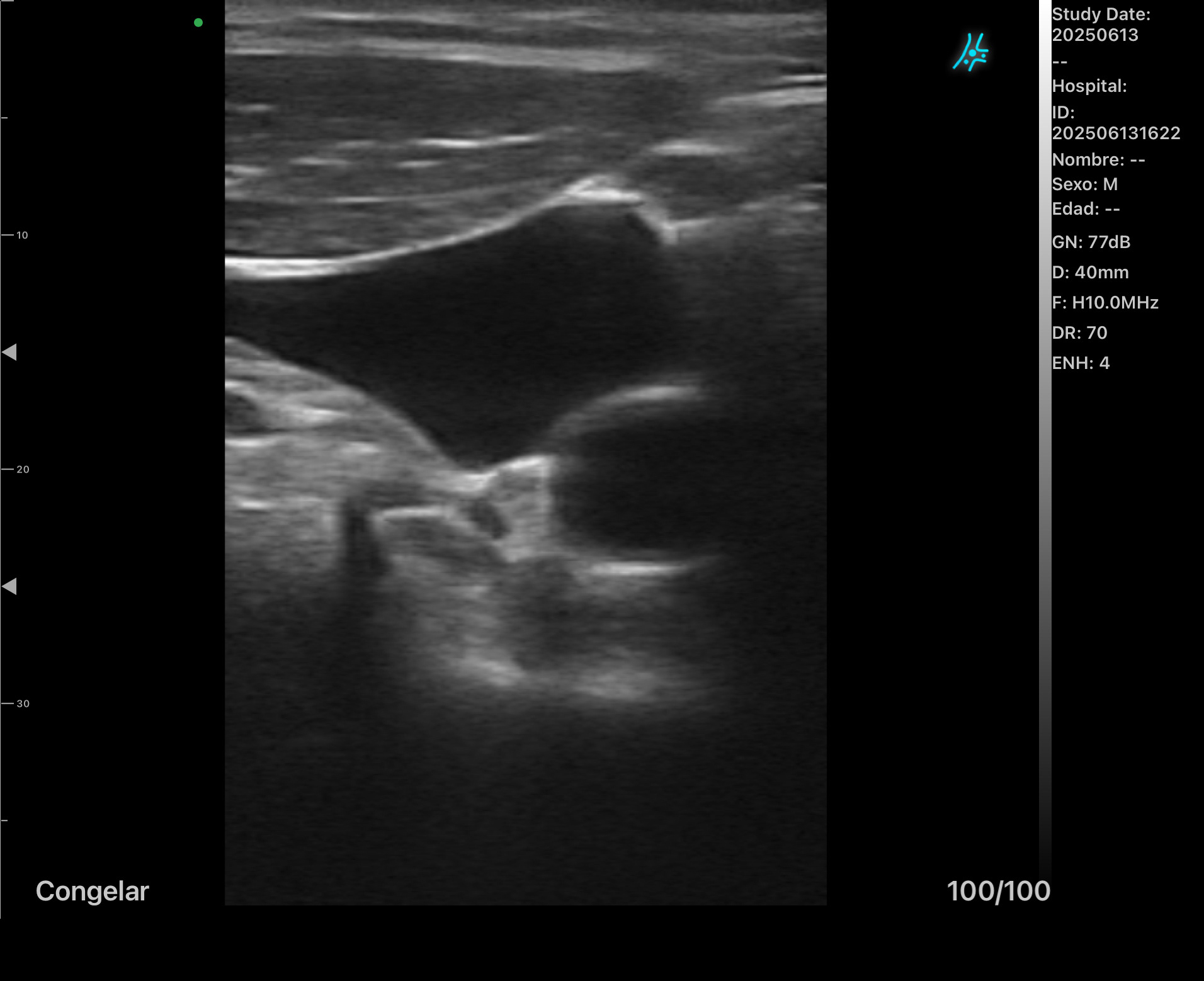 Yugular y Carótida Derecha