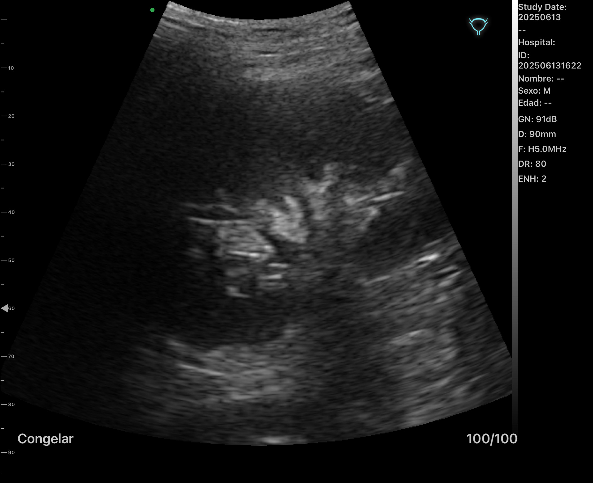 Riñón Izquierdo Normal