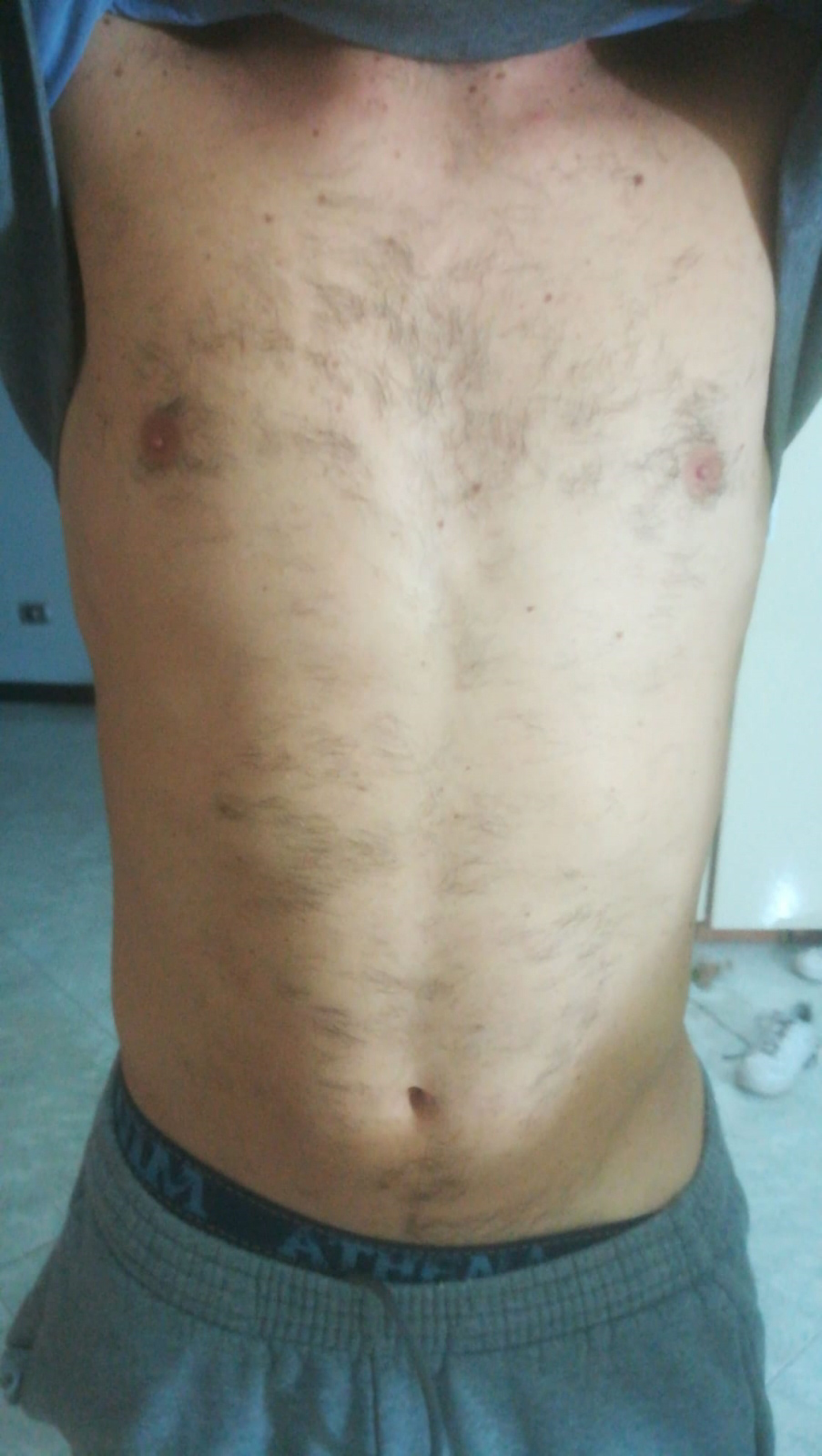 Lo stesso ragazzo a 1 mese ca dalla sua prima seduta laser al Brazilian Beauty Center
