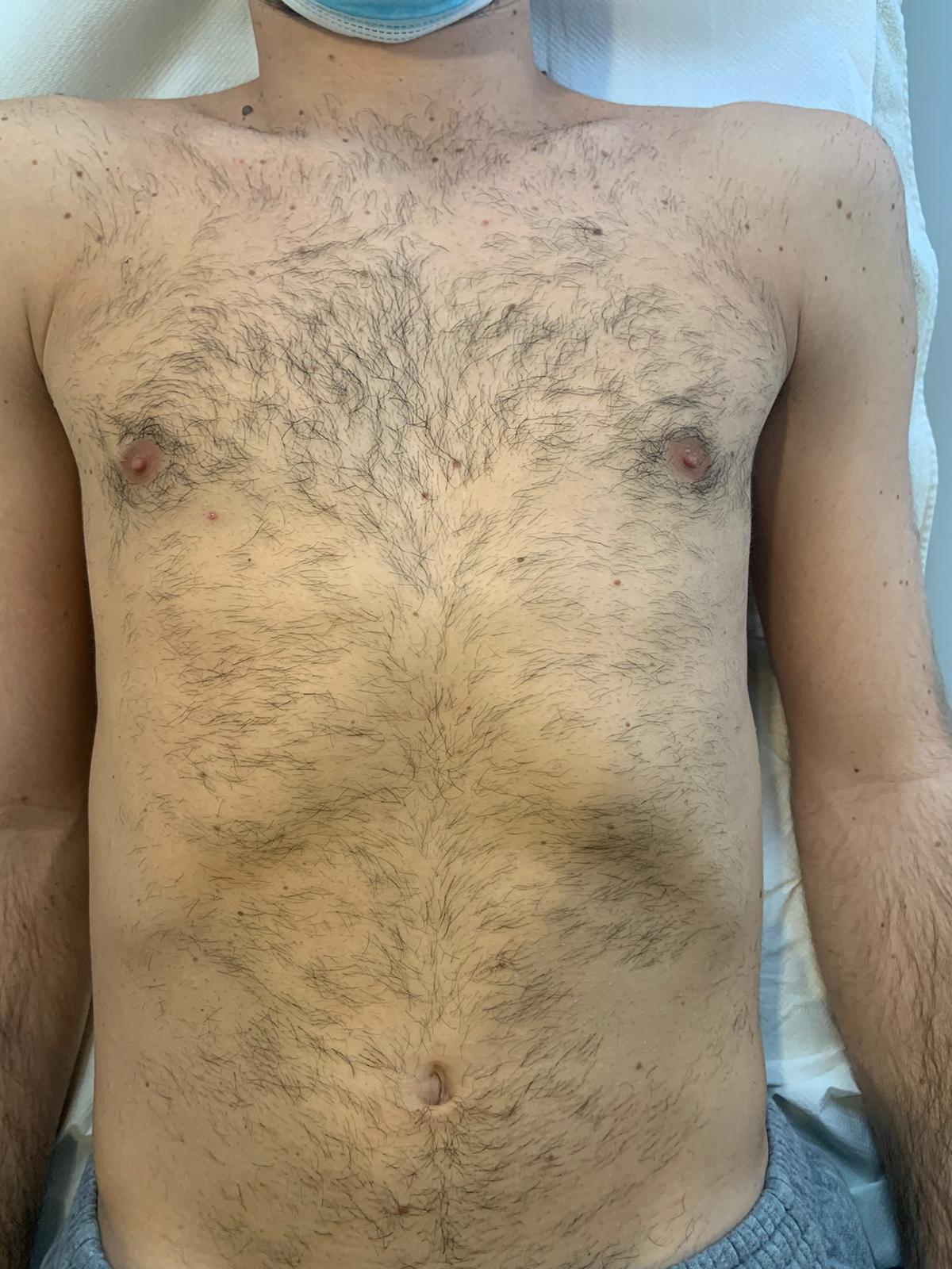 Prima: ragazzo che ha eseguito 7 sedute di epilazione laser in un altro centro