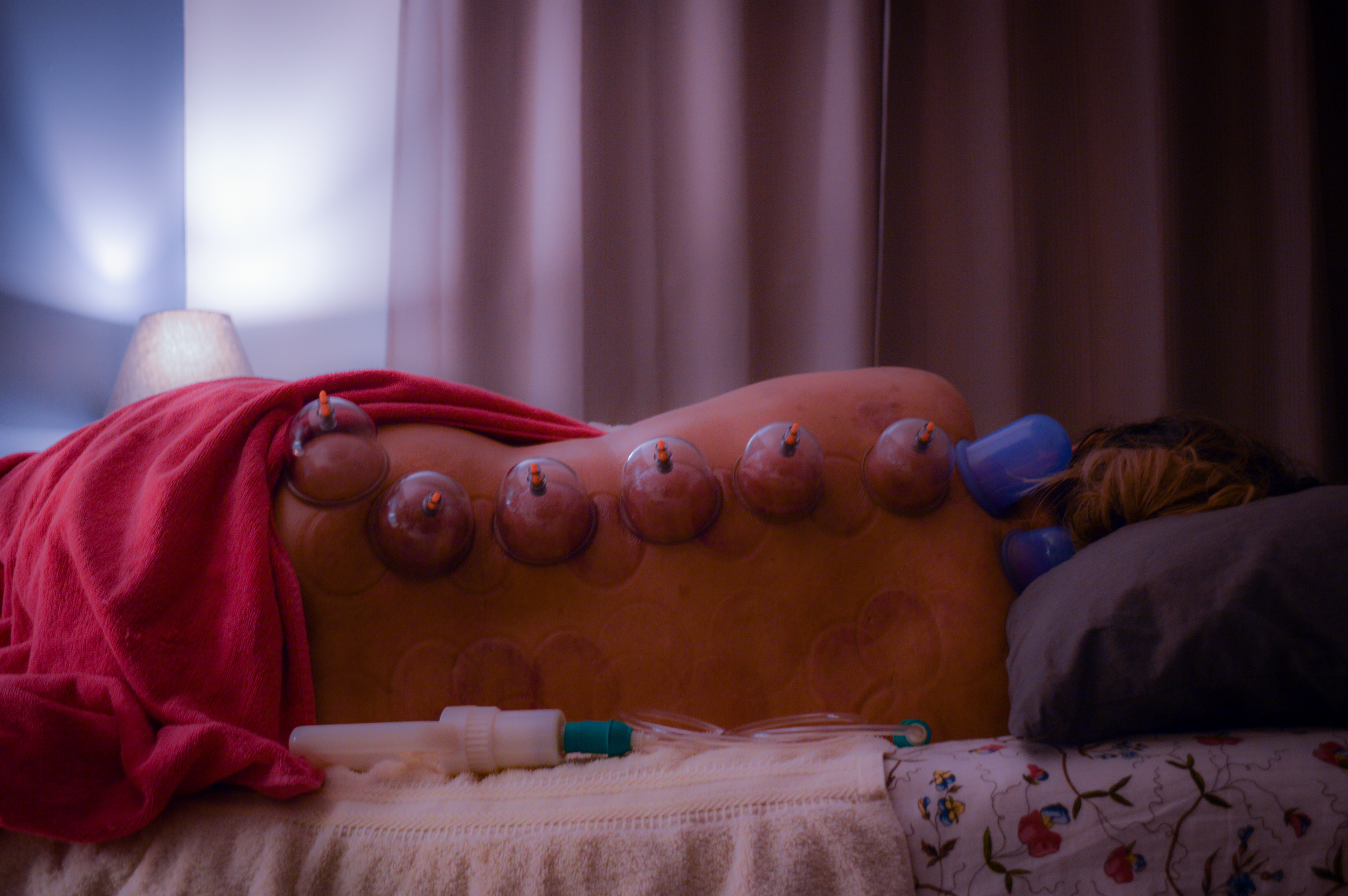 Cupping