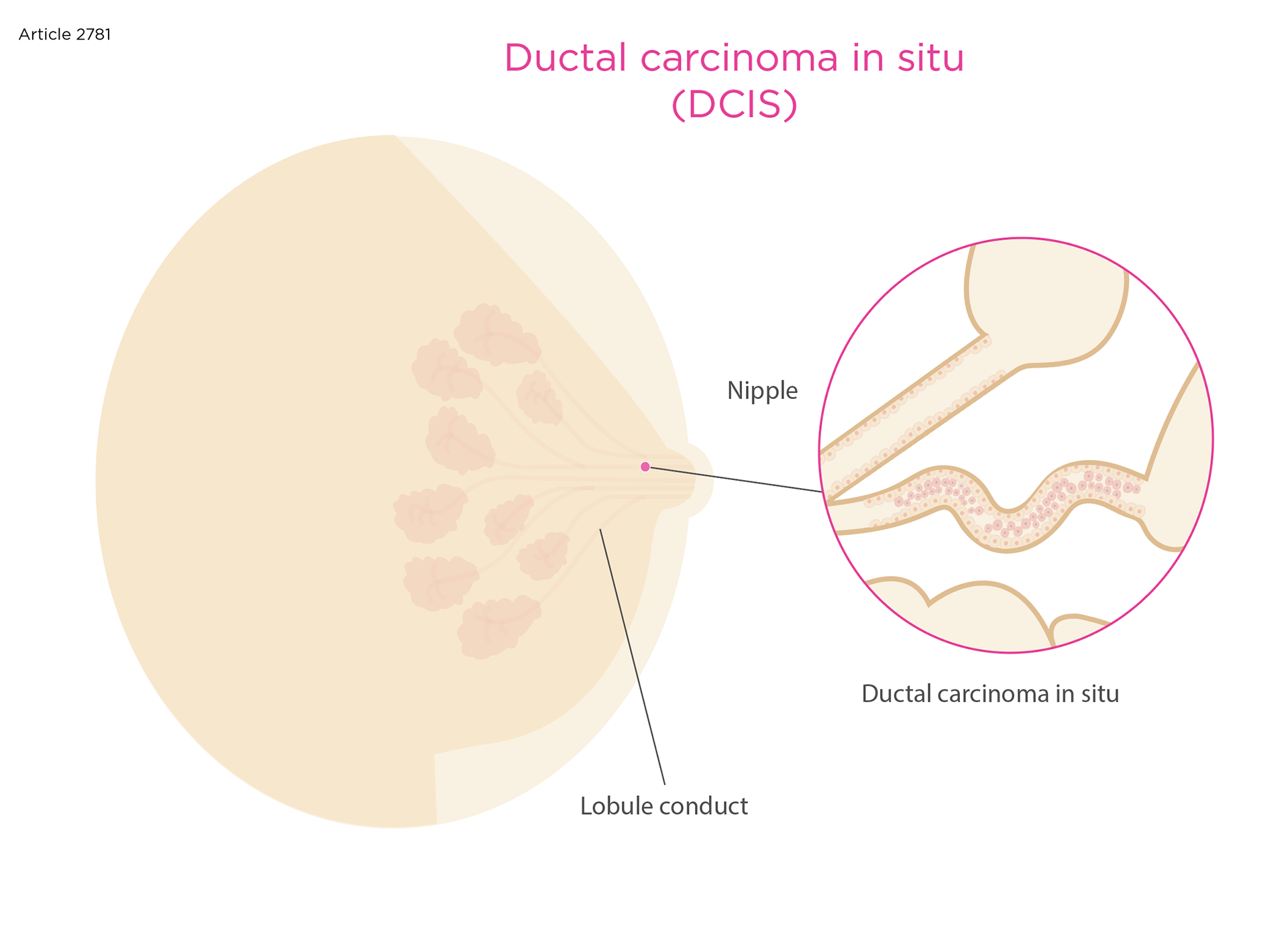 Medical Illustration DCIS