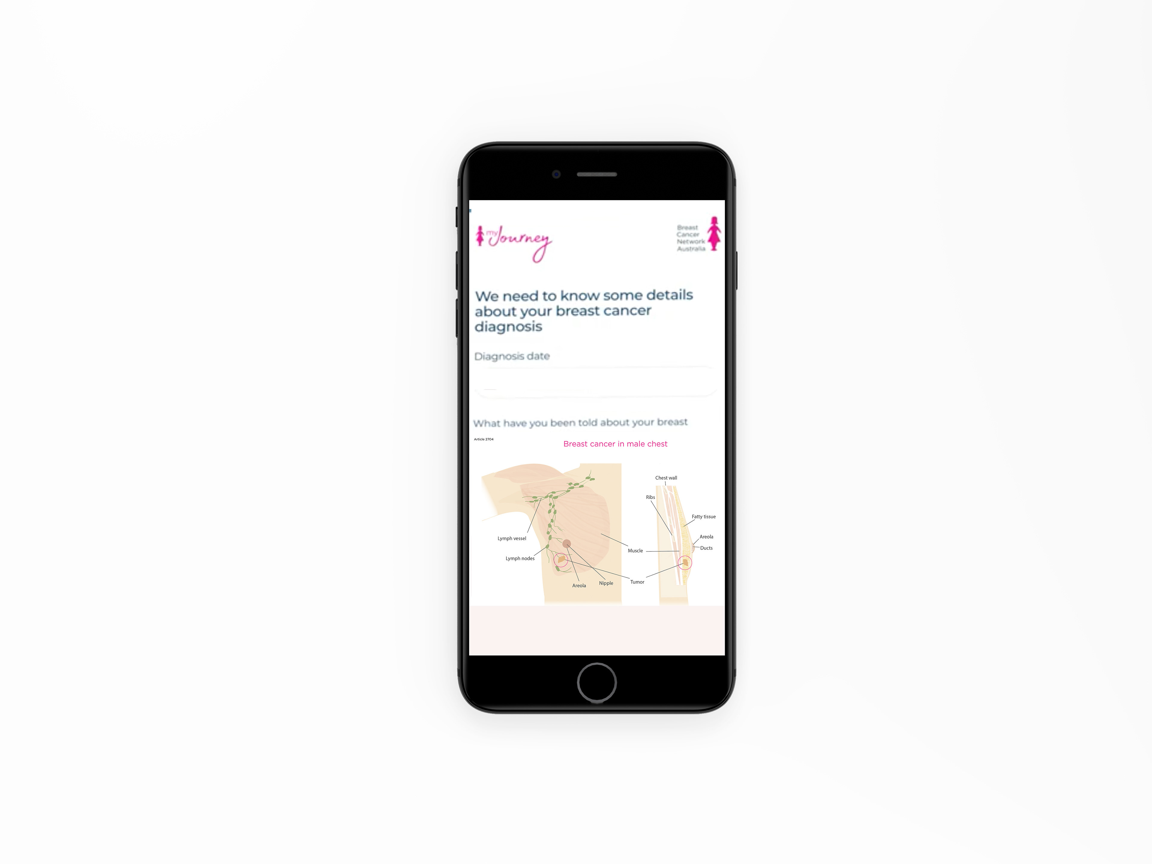 Illustration- Male Breast Cancer