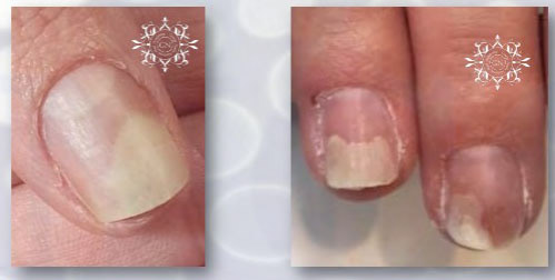 Onycholysis (loslating)