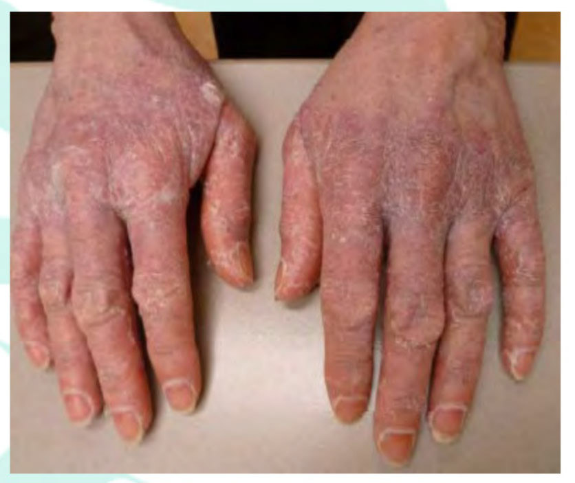 Xerosis (droge huid)