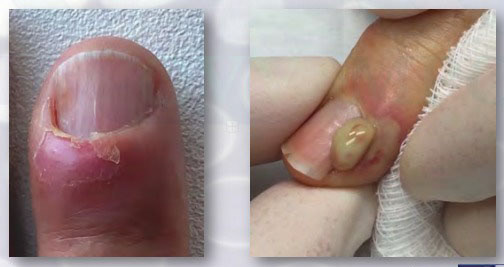Paronychia (ontsteking)
