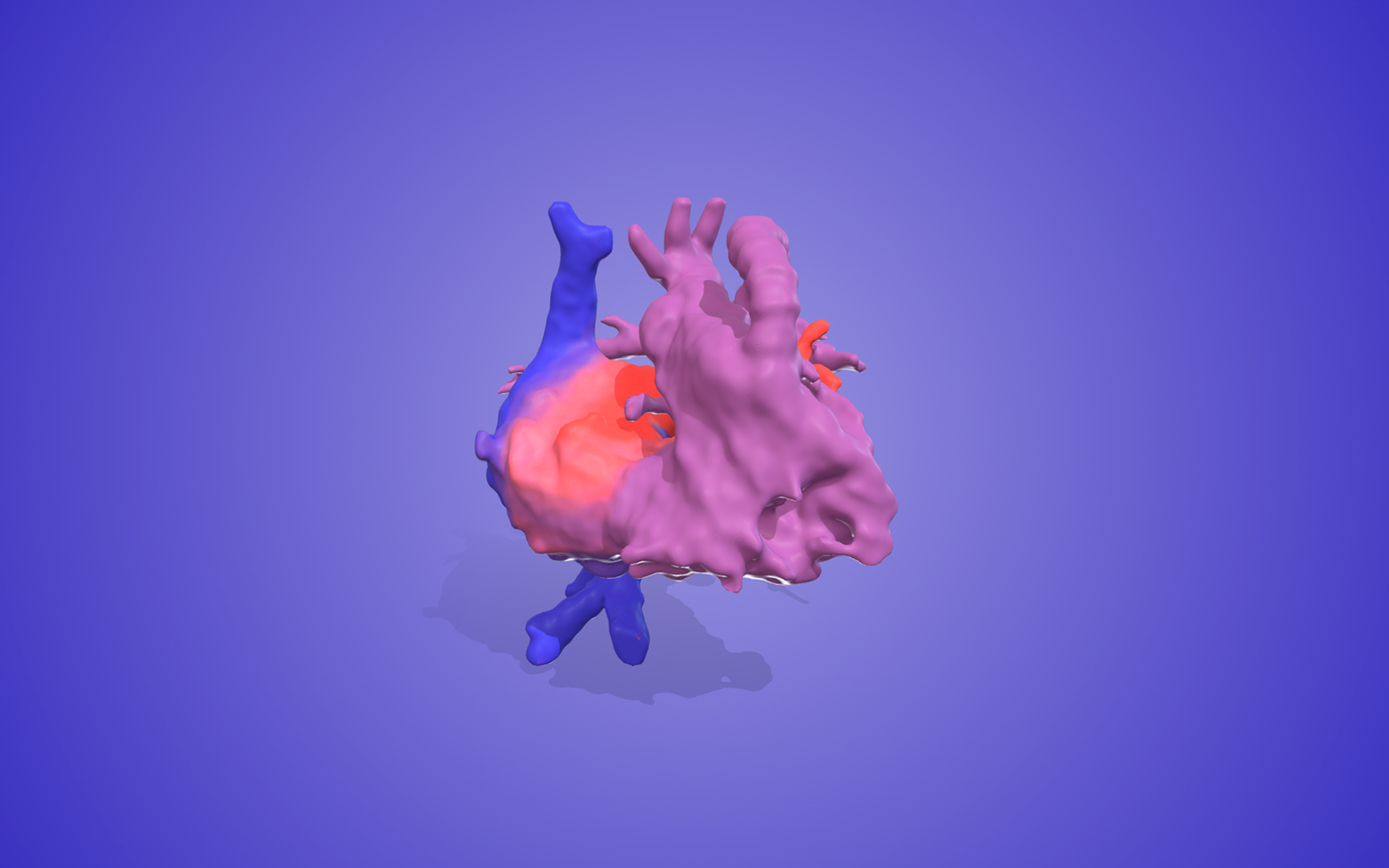 A pediatric heart with hypoplastic heart syndrome, and a Norwood/Sano surgery.