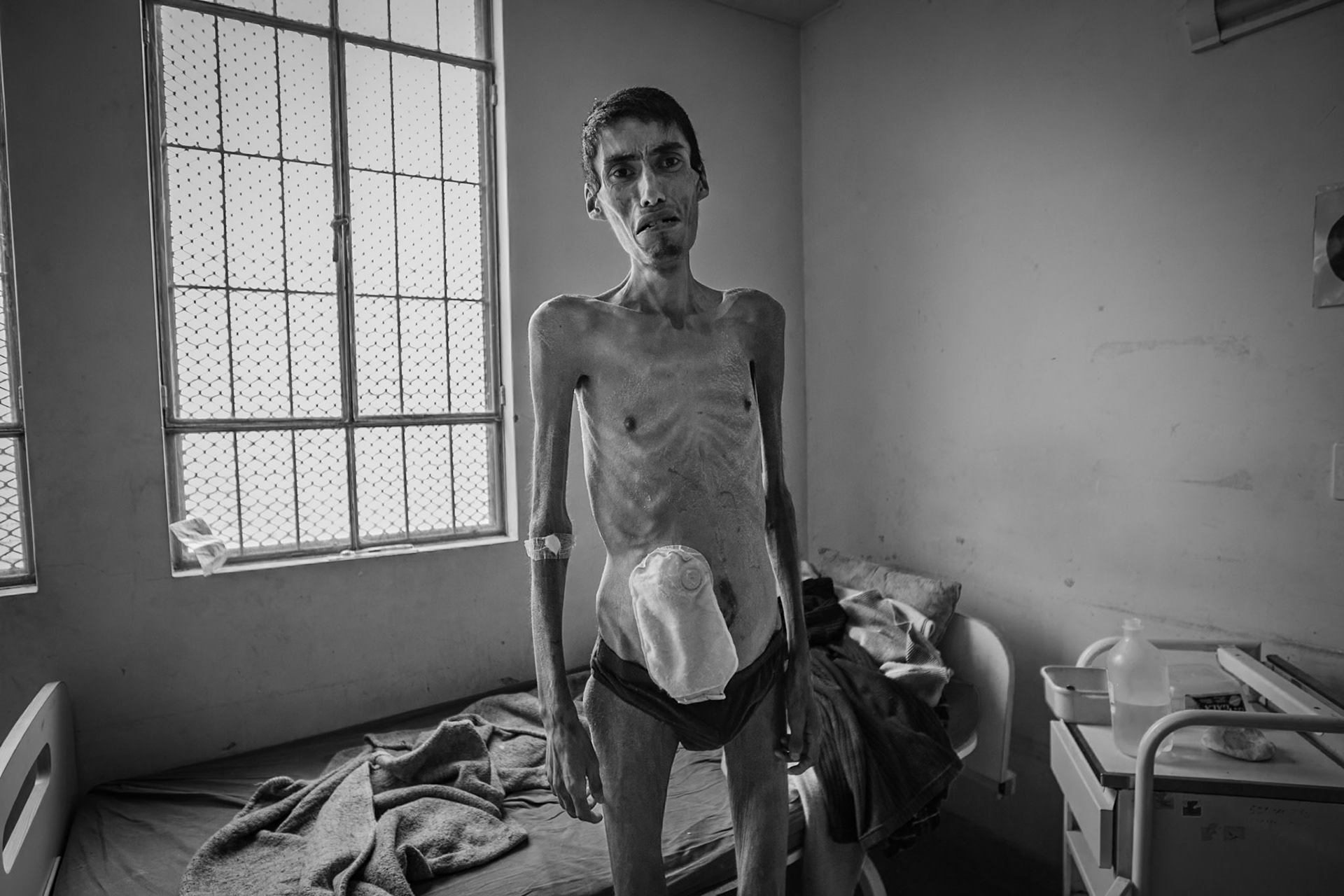 LURIGANCHO PRISON, SAN JUAN DE LURIGANCHO, LIMA, PERU, 2012: Drug dependent inmate in the infirmary. The bag he carries in his stomach is due to a bullet wound.