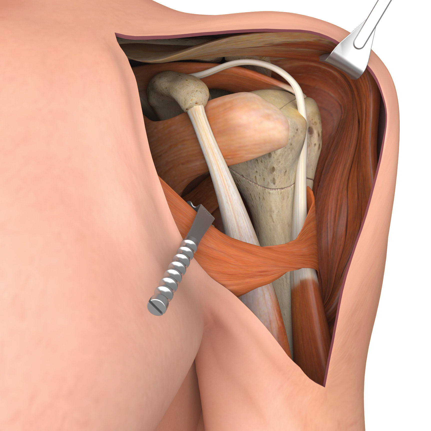 Shoulder Implant Surgery - bone revealed