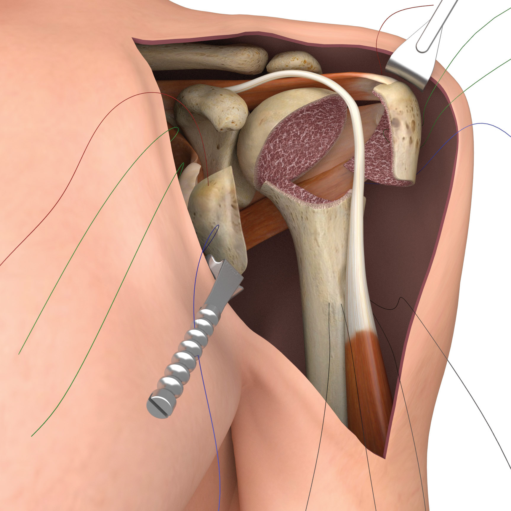 Shoulder Implant Surgery - bone dissection