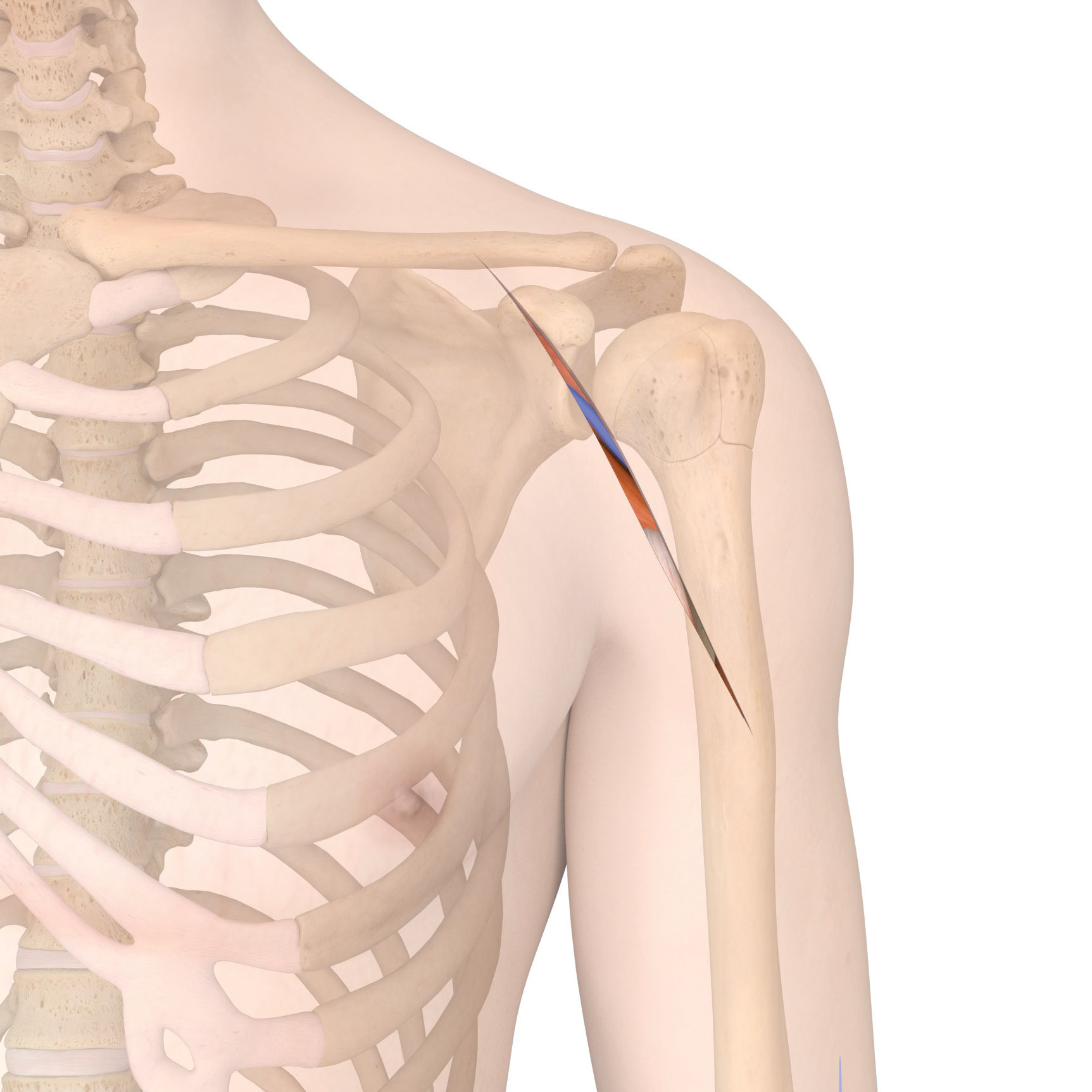 Shoulder Implant Surgery - Incision