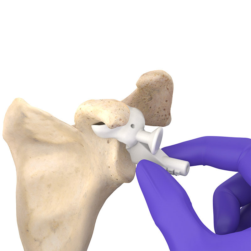 Shoulder Implant - Scapula