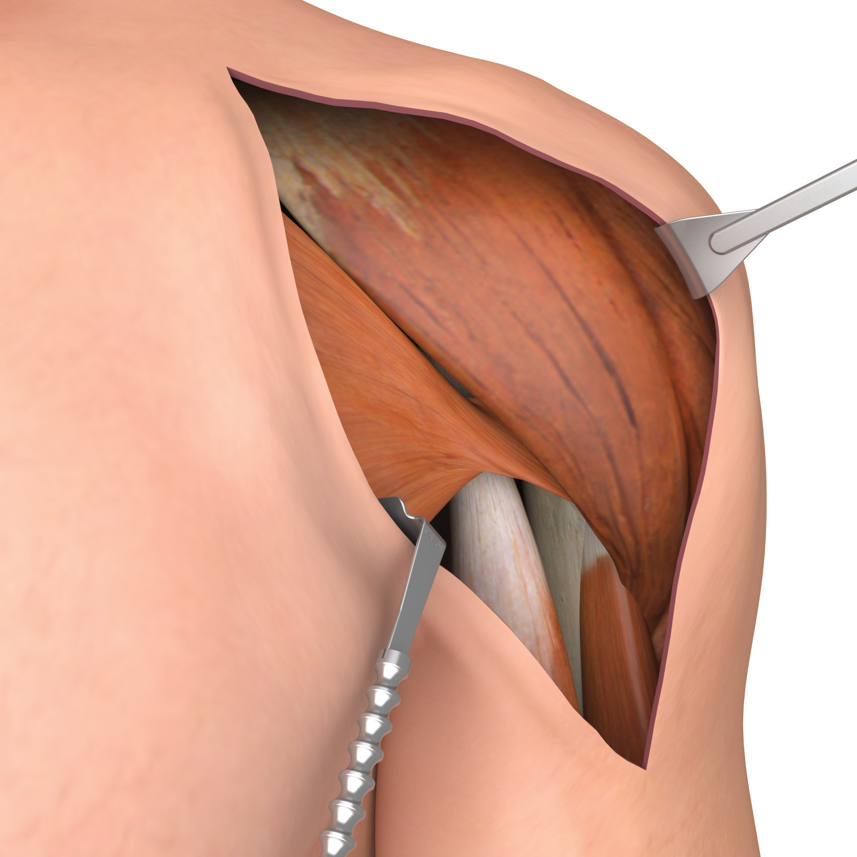 Shoulder Implant Surgery - Exposure