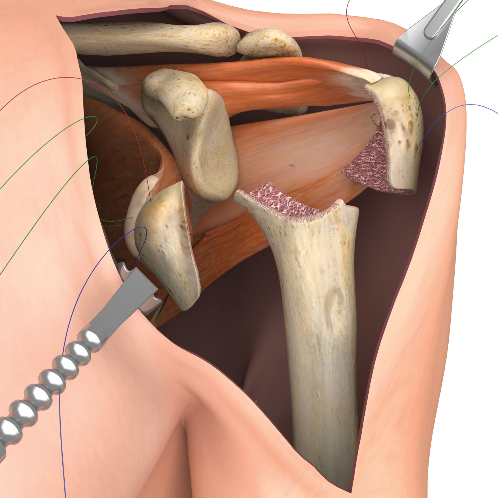 Shoulder Implant Surgery - bone fragment extrusion