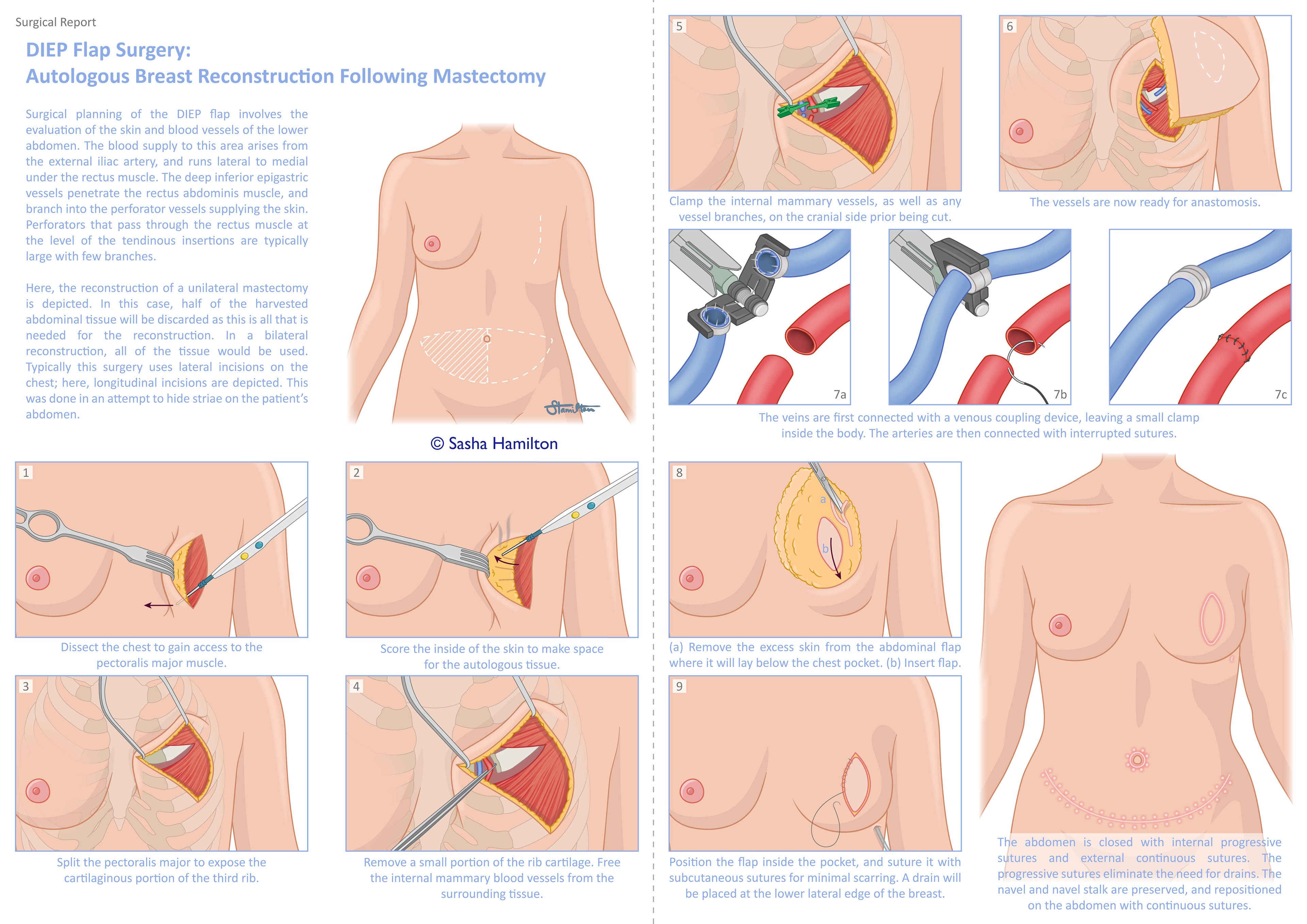 Surgical procedure of a DIEP flap reconstruction following mastectomy, based on observing a live surgery at Maastricht UMC+. The information is presented for a medical audience, with focus on the chest portion of the surgery. Adobe Illustrator. 2023.