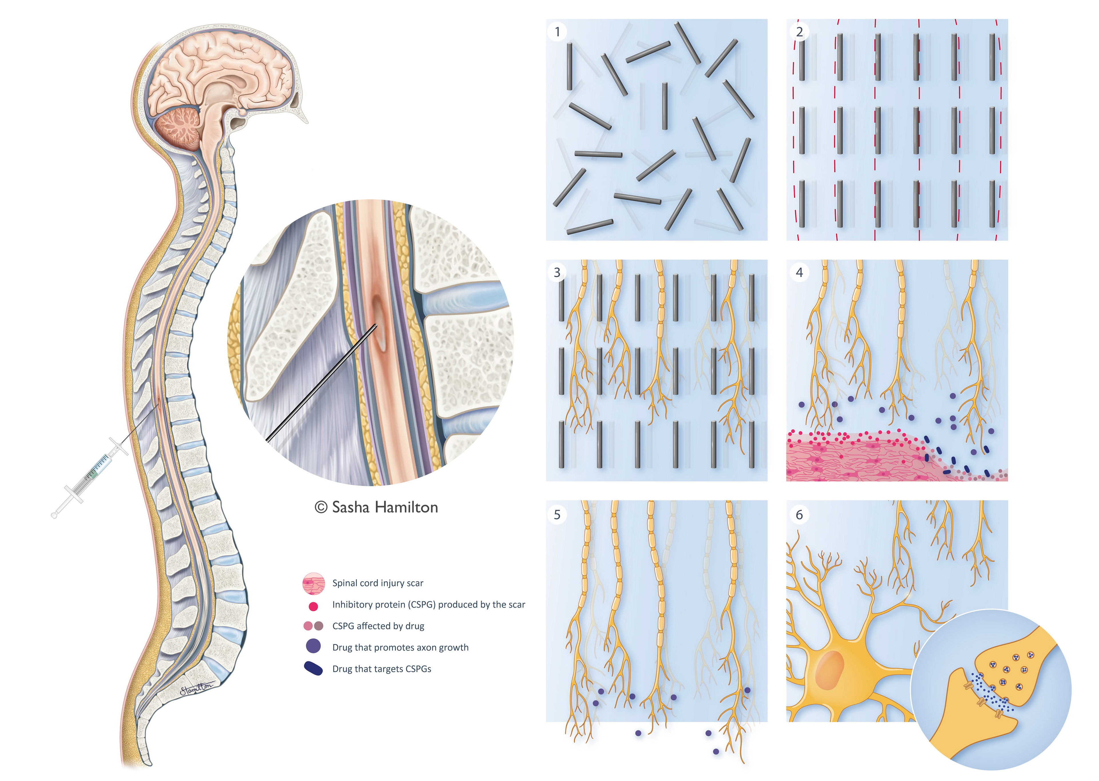 Illustration created as part of my master’s thesis to explain the research behind a potential treatment for spinal cord injury. In this treatment, an injectable hydrogel is delivered into the injury site which will allow damaged nerve cells to grow and reconnect through the injury. Adobe Photoshop, Adobe Illustrator. 2024.