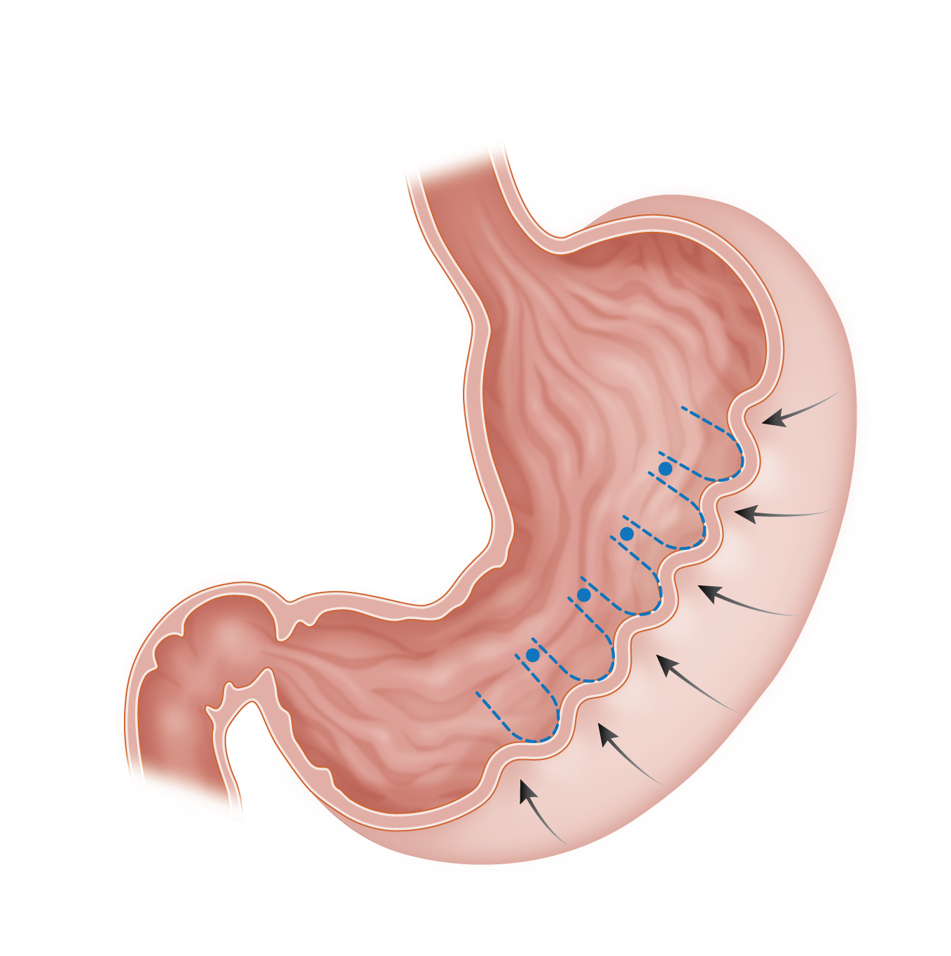 American College of Gastroenterology: Endoscopic sleeve gastoplasty
