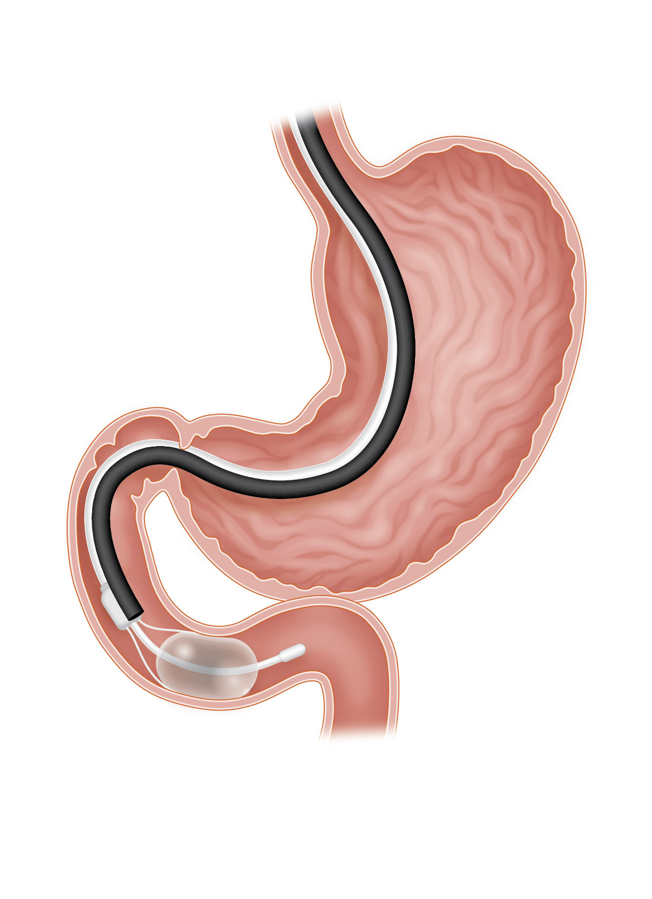 American College of Gastroenterology: Duodenal mucosal resurfacing