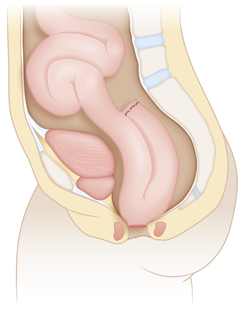 American College of Gastroenterology: J-pouch