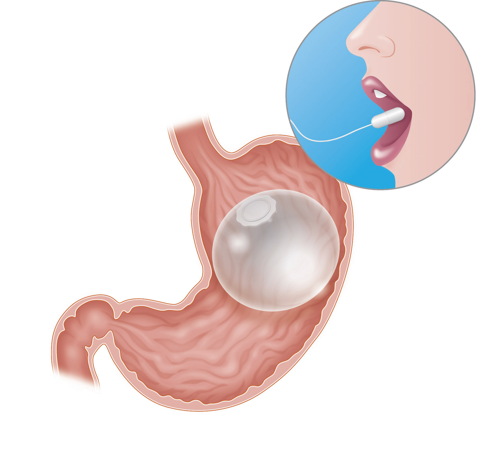 American College of Gastroenterology: Elipse balloon