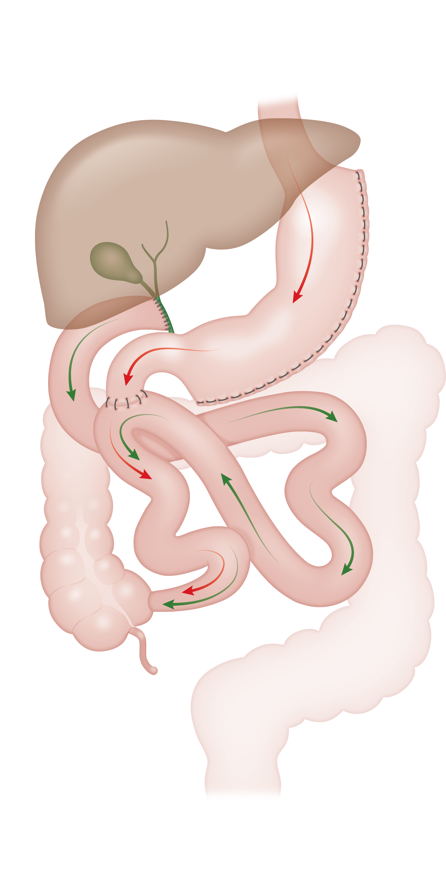 American College of Gastroenterology: Single anastomosis duodenalileal bypass