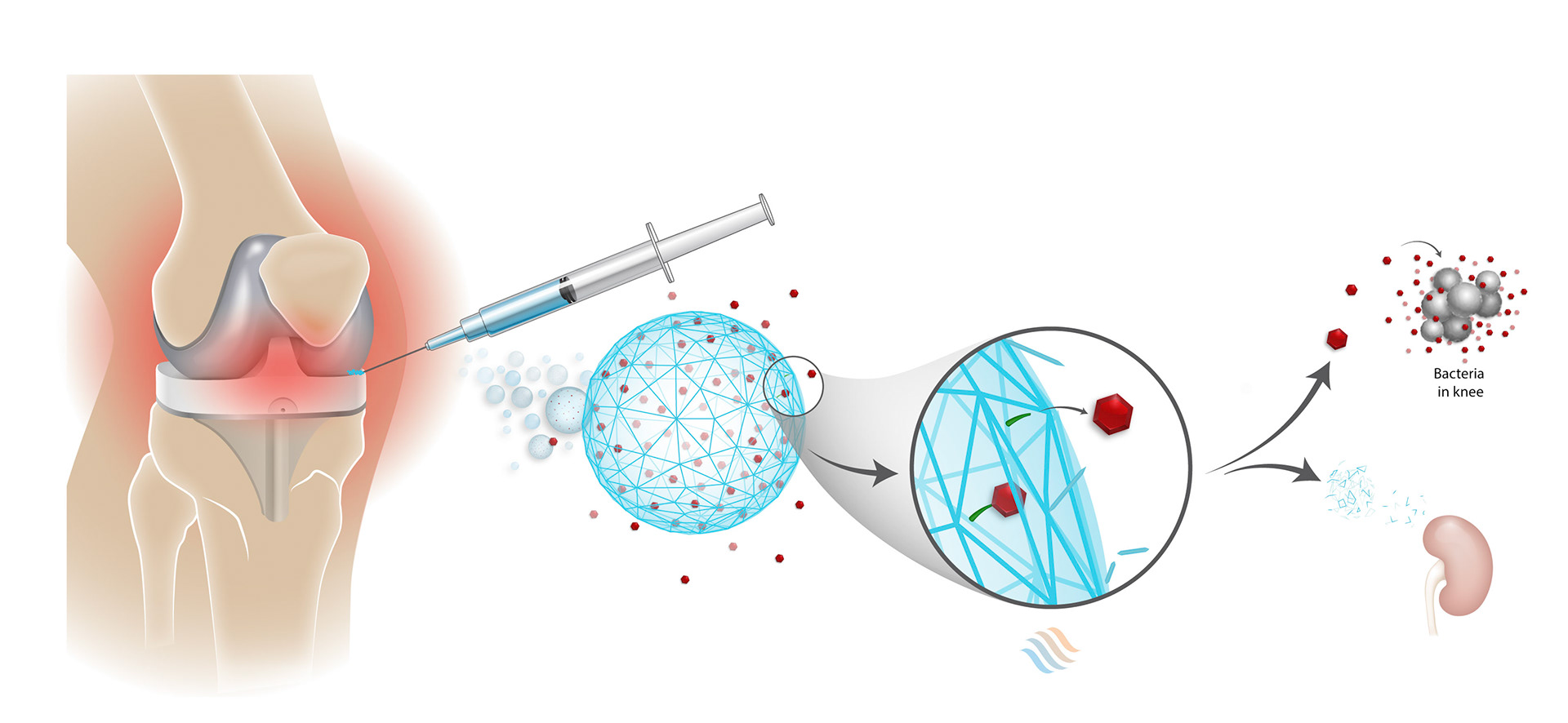 MOA illustration_Ascendis hydrogel prosthetic V4