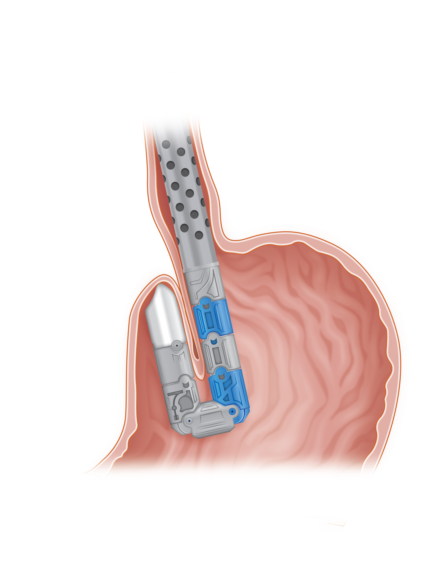 American College of Gastroenterology: Transoral Incisionless  Fundoplication