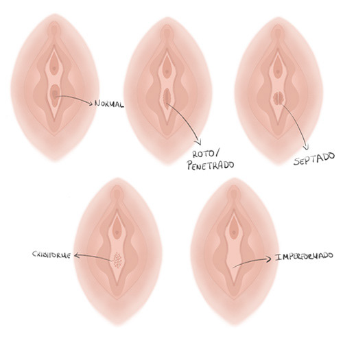 Different types of hymen.