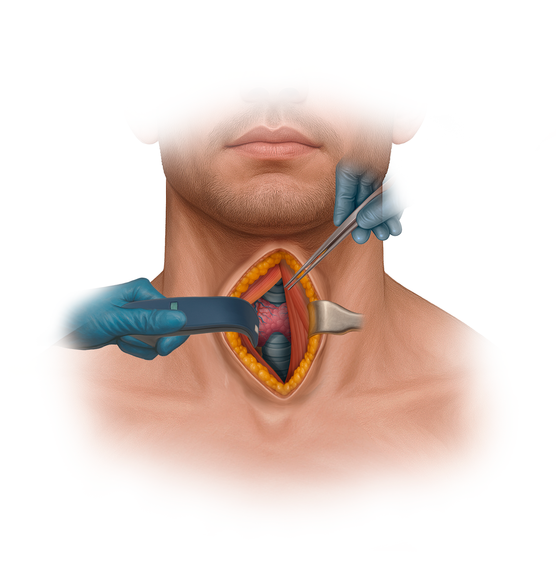 Thyroidectomy Procedure