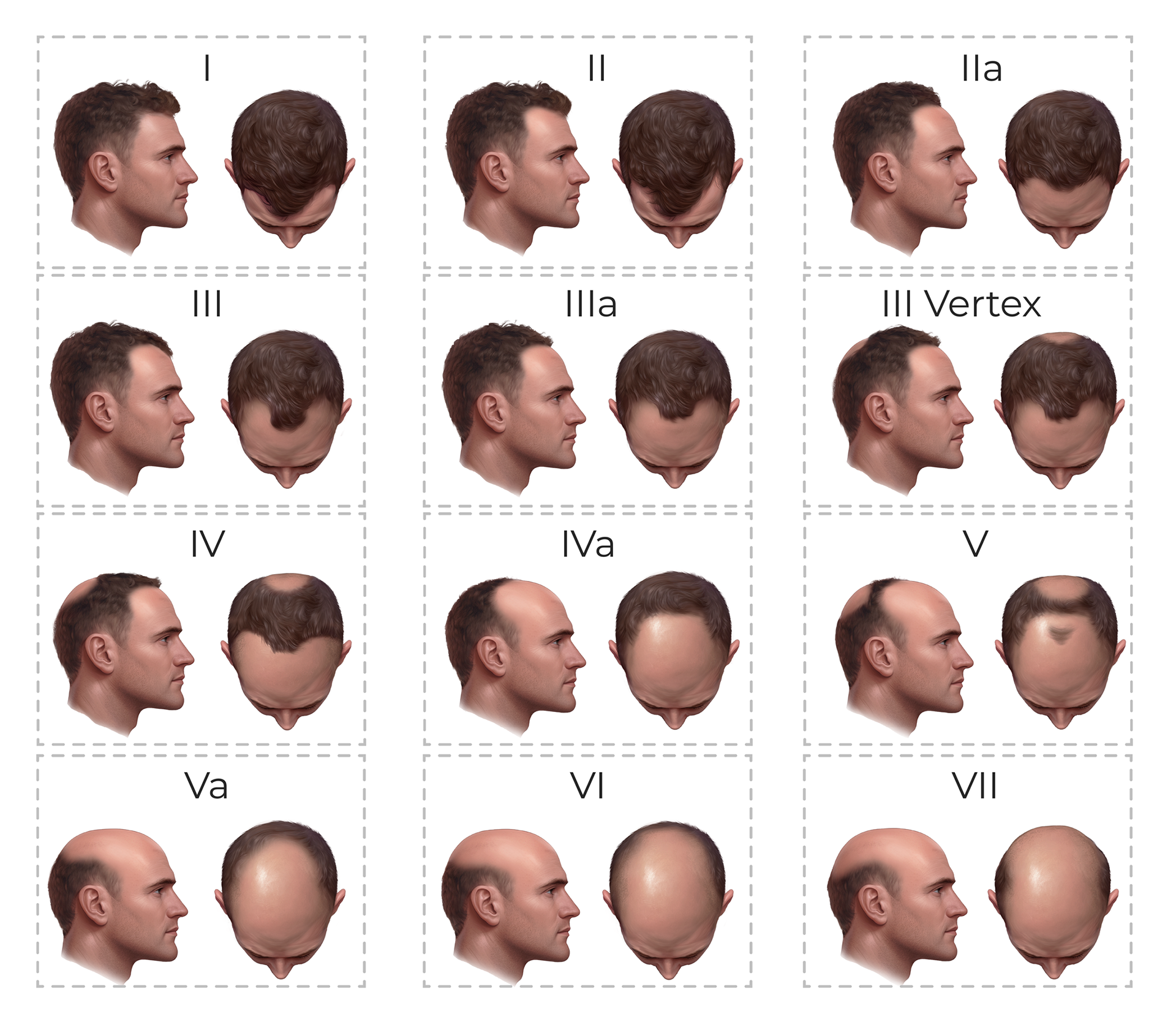 Male Pattern Baldness Stages