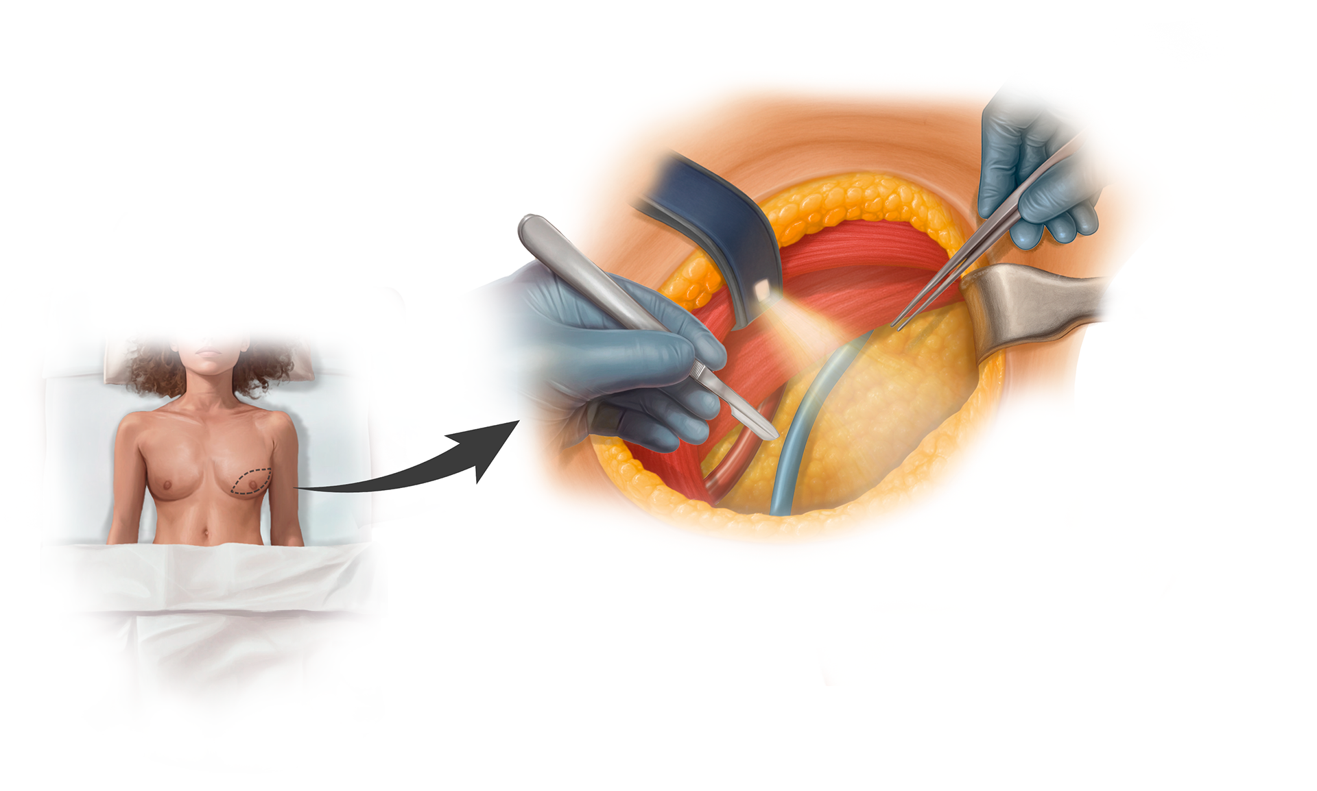 Mastectomy and Surgical Access