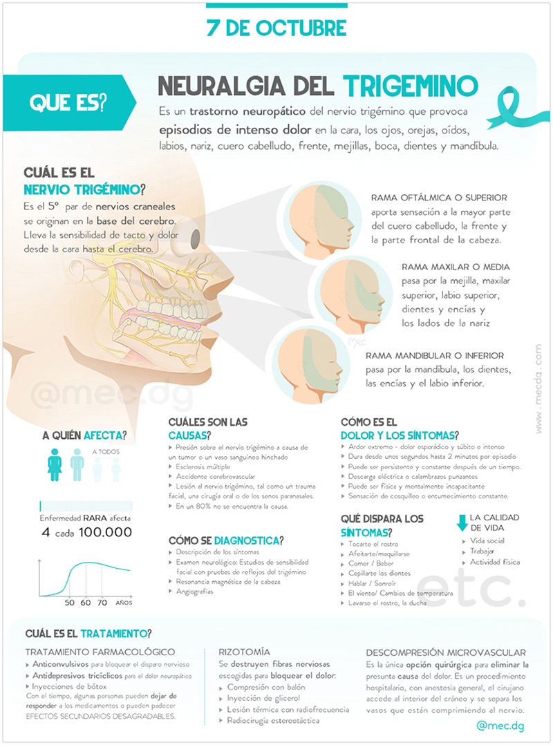 infografía, diseño de infografías, iconos, ilustraciones, ilustradora, neuralgia del trigemino, trigeminal neuralgia