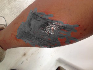 Cuts and Scrapes