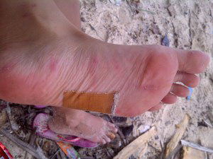 After I cleaned my wounds