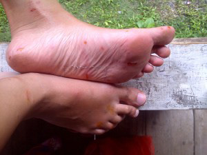 Cleaning up my coral wounds After I cleaned my wounds