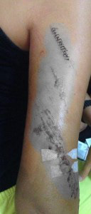 My wounds after 2 weeks from the tragedy