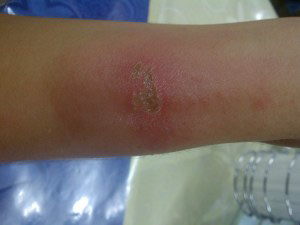 My wound