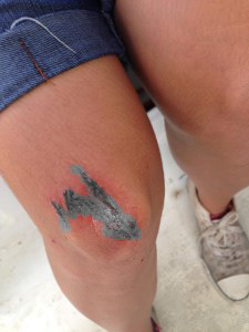 Deep cut on the knee part