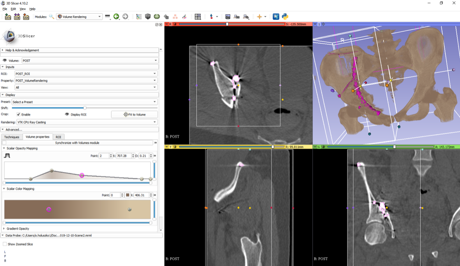 DVR of pelvis post-surgery to show pins