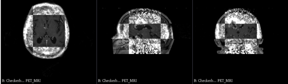 Aligning MRI and PET datasets