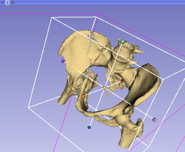 iDVR of pelvic fracture